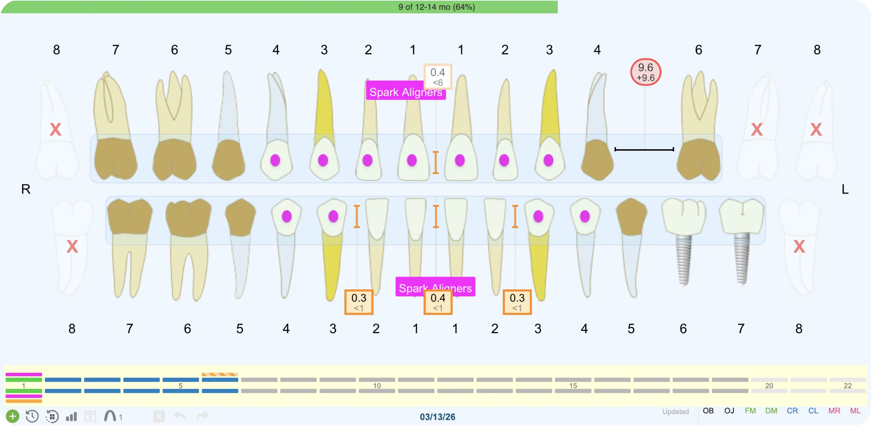 Visual tooth chart showing aligner attachments, IPR markers, and treatment progress