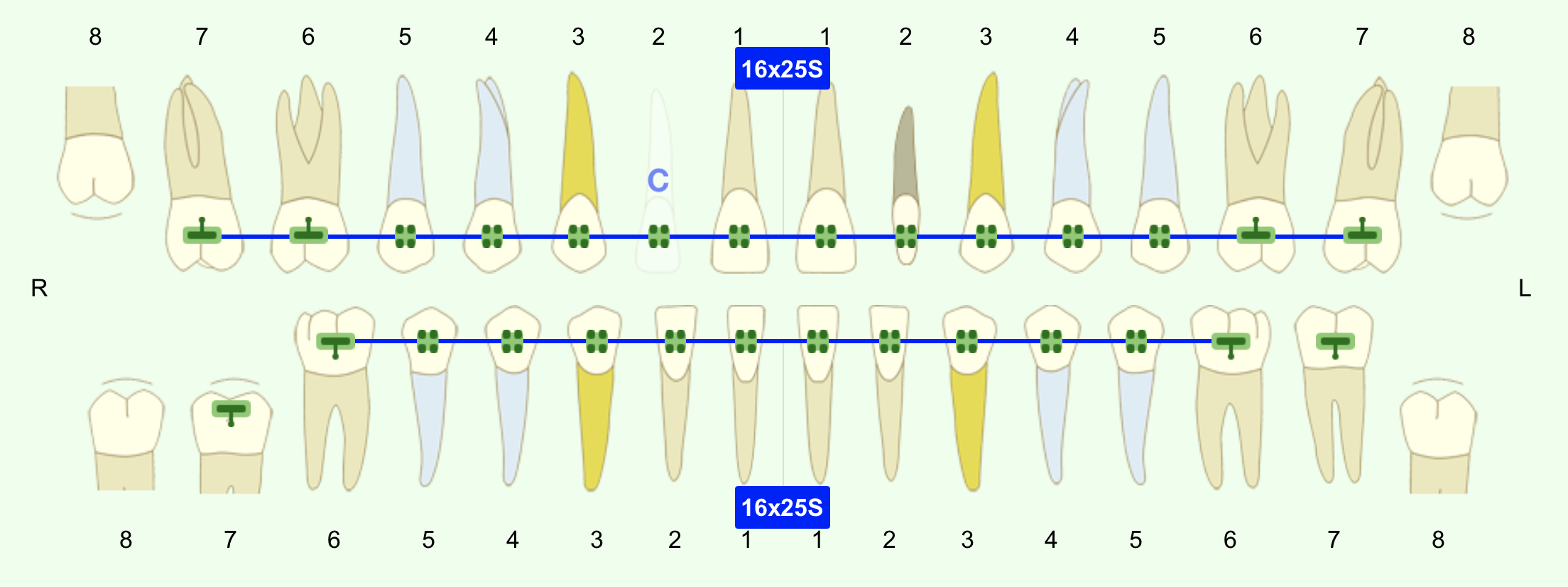 A screenshot of the Tooth Chart with a green background, indicating that the next appointment is being edited