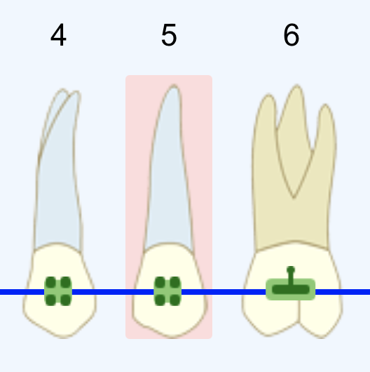 A small screenshot of 3 teeth from the tooth chart, with one tooth highlighted in red to indicate something important about it